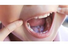 Photo of أعراض تبديل الأسنان عند الأطفال
