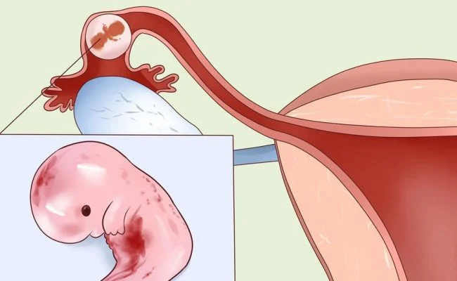 هل ألم الرقبة من علامات الحمل خارج الرحم