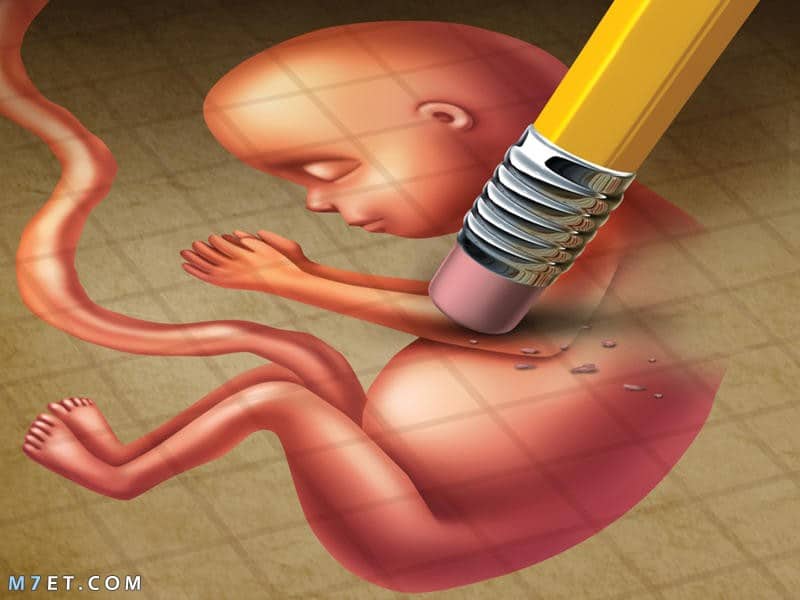 أنواع وطرق ووسائل الإجهاض