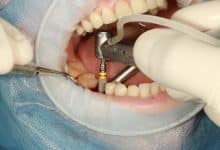 Photo of تجربتي في زراعة الأسنان | أهم 4 بدائل لزراعة الأسنان