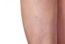 Photo of ما هو أفضل مرهم لعلاج الدوالي