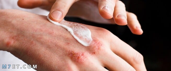 علاج حساسية اليدين والحكة