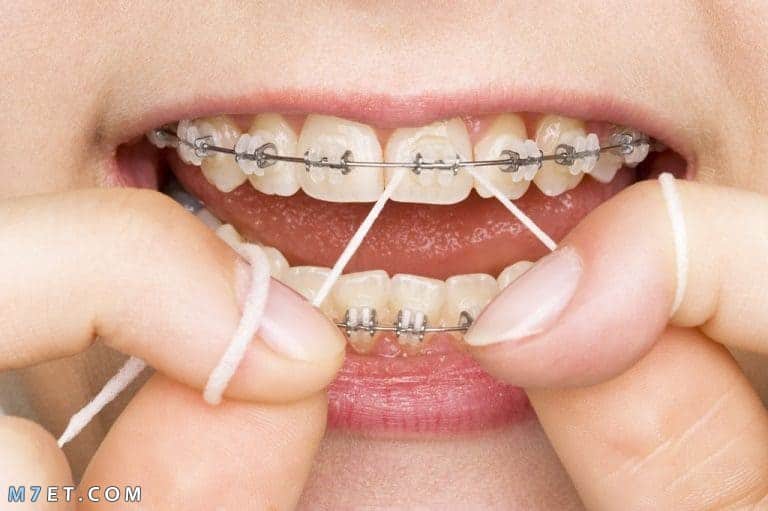 عملية تقويم الأسنان