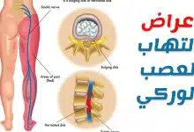 Photo of أعراض العصب الوركي