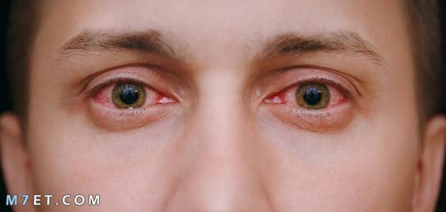  أمراض بؤبؤ العين
