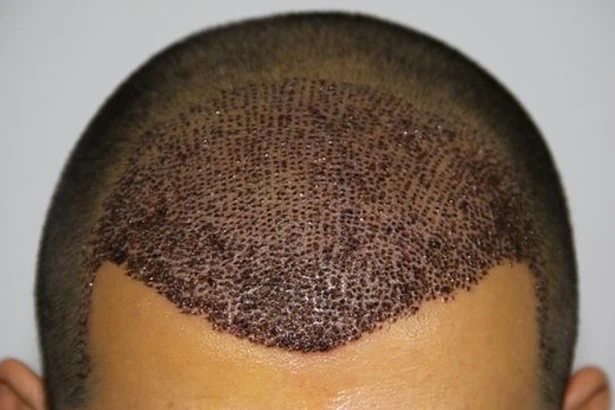 تكلفة زراعة الشعر في دبي