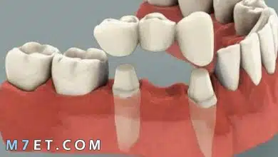 Photo of معلومات حول تركيب الأسنان الثابتة