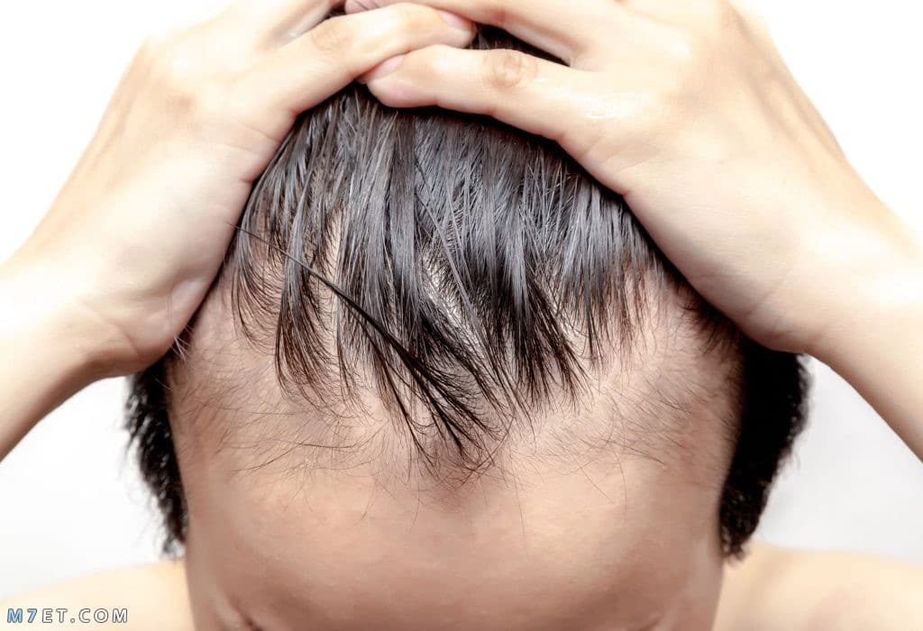 أشهر hair regain لعلاج الصلع وتساقط الشعر