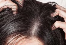 Photo of علاج القشرة في الشعر من أول مرة