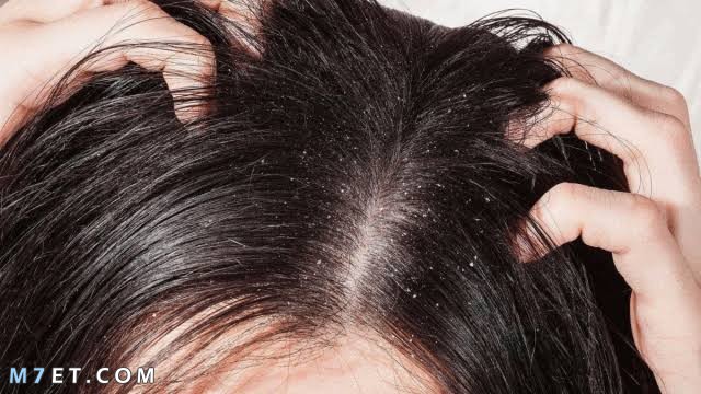 علاج القشرة في الشعر من أول مرة صورة رقم 1