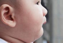 Photo of بقع بيضاء في الوجه عند الاطفال الرضع