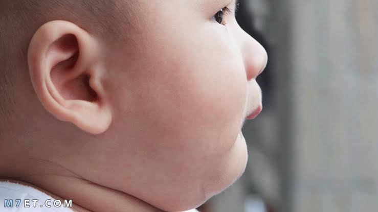 بقع بيضاء في الوجه عند الاطفال الرضع