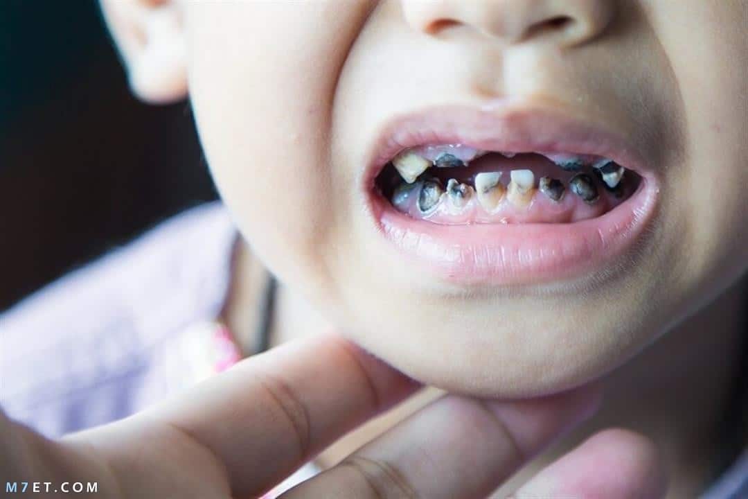 علاج ألم الأسنان عند الأطفال 7 سنوات