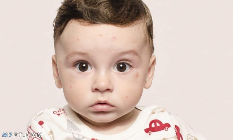 علاج البقع البيضاء في الوجه للاطفال