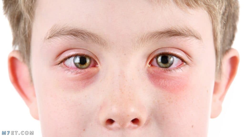 مرهم لعلاج الكدمات حول العين للأطفال