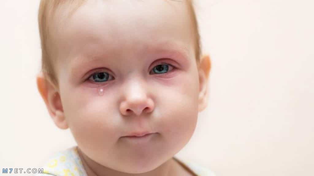 مرهم لعلاج الكدمات حول العين للأطفال